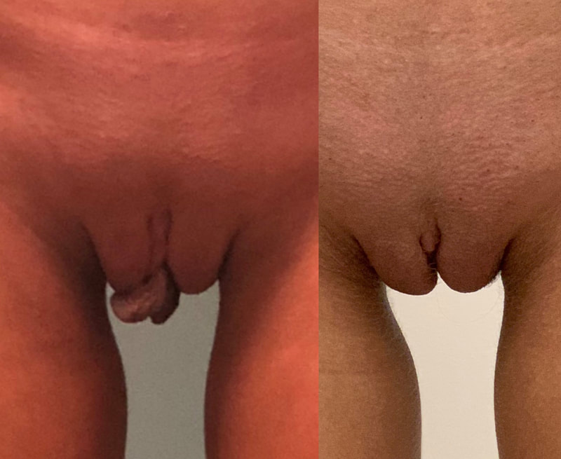 The Labiaplasty - Before & After